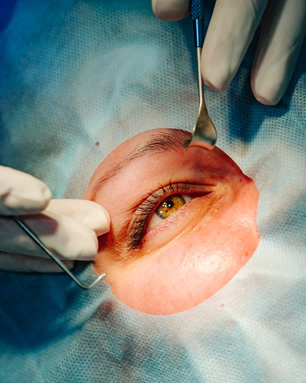 Transplante de Córnea Maringá